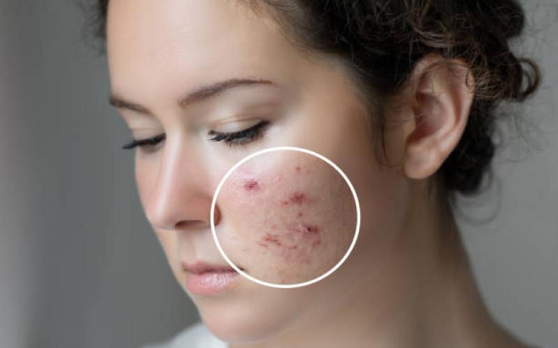 What Makes Laser Treatments Effective for Acne Scars in Riyadh?