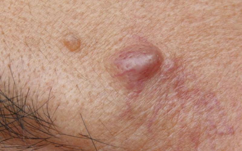 A Complete Overview of Sebaceous Cyst Removal Treatments