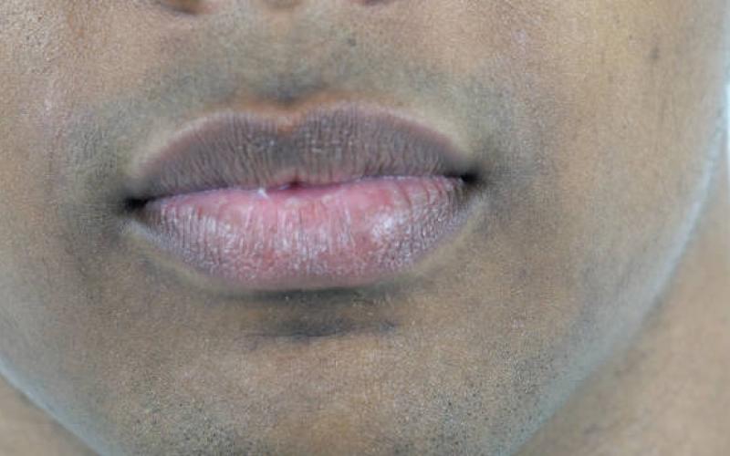 Smoker’s Lips Treatment for Healthier and More Attractive Lips