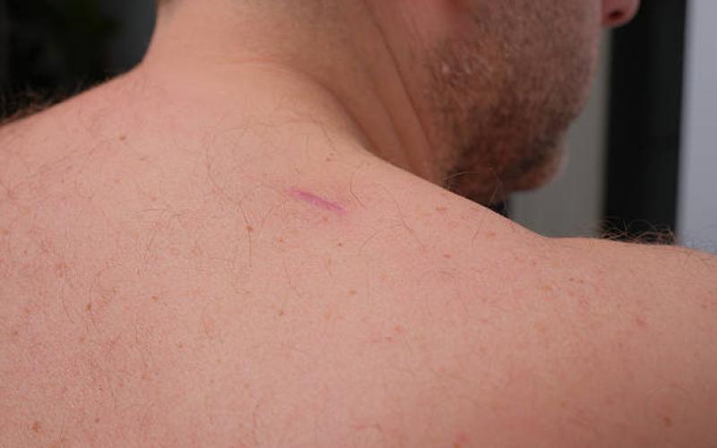 Laser Scar Removal for Smoother Skin and Better Texture Results