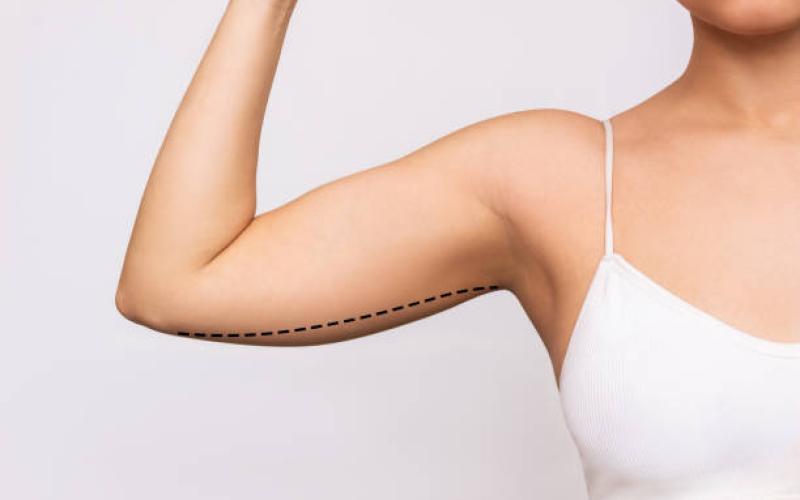 Arm Lift Surgery: How Surgeons Customize Your Plan