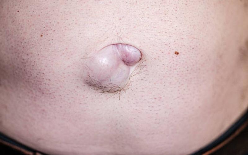 Hernia Surgery Cost and Recovery Process Explained