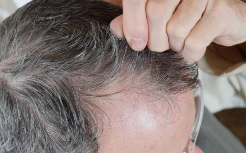 Hair Loss Treatment to Improve Overall Hair Wellness